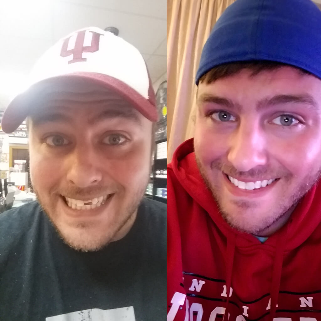 Temptooth™ #1 Temporary Tooth Replacement (Lowest Price Guaranteed)